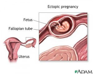 diagram of ectopic pregnancy